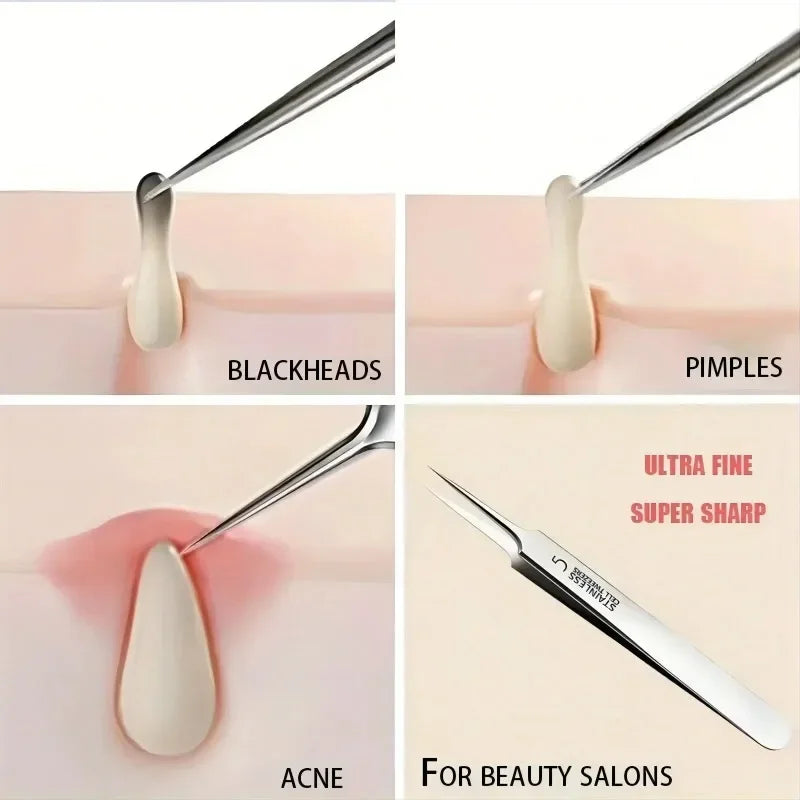 Pinza extra fina para espinillas y acné. Remueve los puntos negros de tu piel